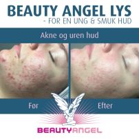 Beauty Angel behandlinger mod akne i Ulfborg