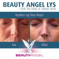 Beauty Angel behandling hos klinik Skinstyle i Ulfborg