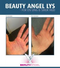 Beauty Angel behandlinger mod problematisk hud i ulfborg
