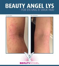 Beauty Angel behandling mod eksem i Ulfborg